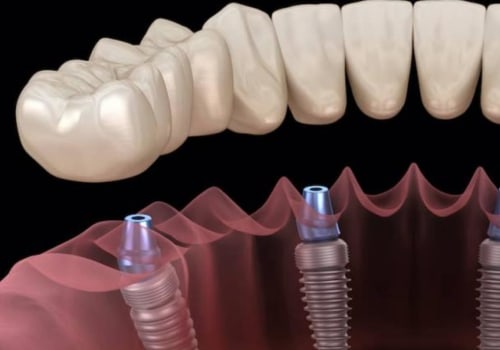 What is the best implant for teeth?