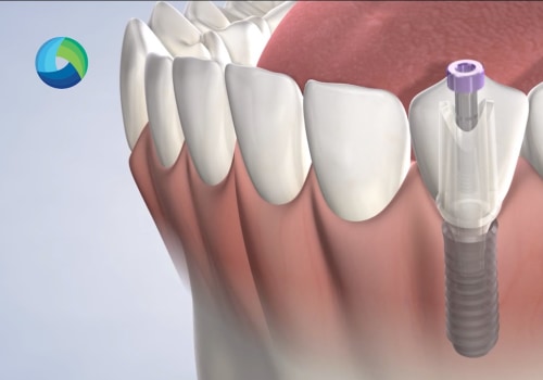 What You Need To Know Before Getting Dental Implants In New Jersey