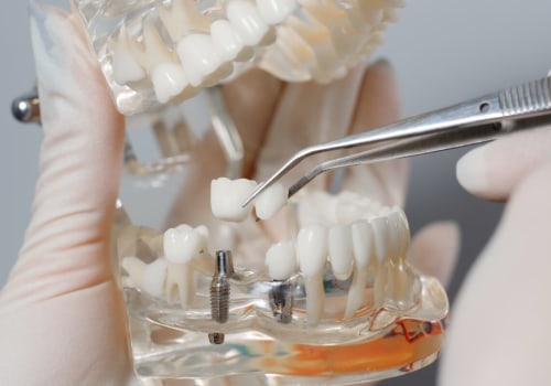 Will dental implants get cheaper?