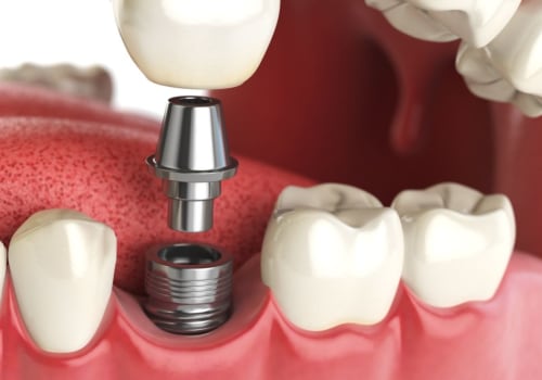 Which is the best type of dental implants?