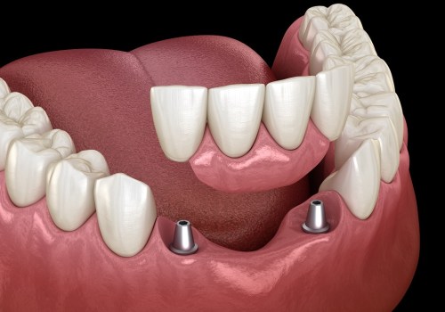 Restoring Confidence: Dental Implants In Hillsboro For A Natural-Looking Smile