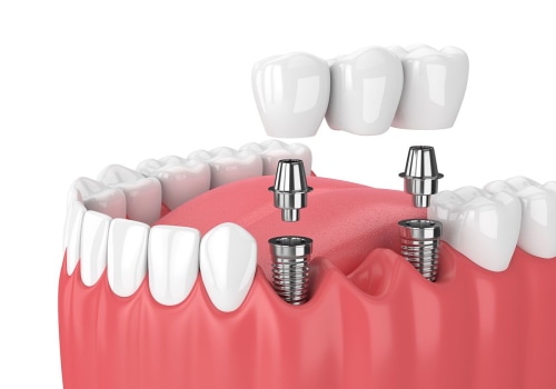 Dental Implants: The Modern Solution For Missing Teeth In Commerce City