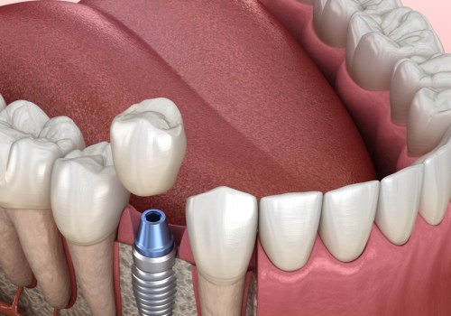 Why Are Dental Implants The Most Effective Treatment In Boerne For Tooth Loss And Damage