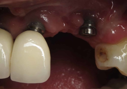 Why dental implants fail?