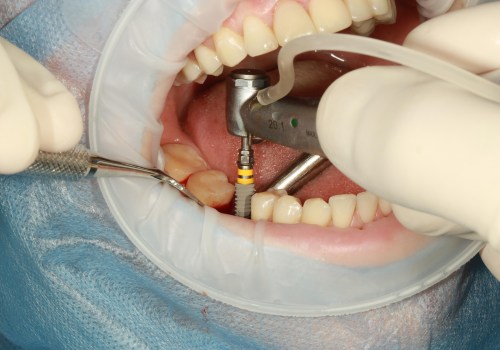 Dental Implants in Switzerland: Modern Solutions for Lasting Smiles