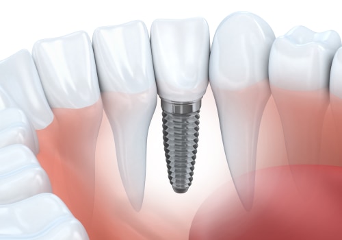 Choosing The Right Dentist For Dental Implants In Rockville, MD
