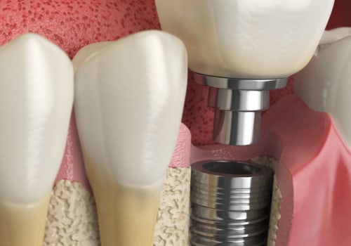 What To Expect When Getting Dental Implants In Ellsworth