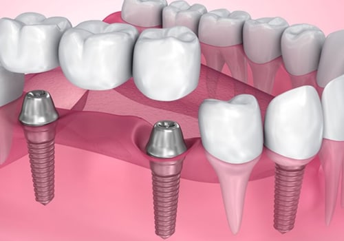 Why dental implants are important?