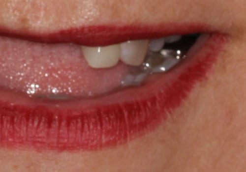 The Life-Changing Impact Of Dental Implants In San Antonio