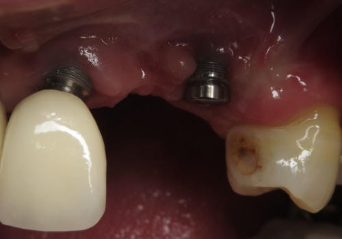 Do dental implants ever have to be removed?
